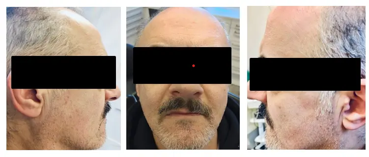 Figure 1: Initial clinical situation of poorly fitting complete dentures