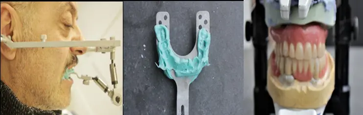 Figure 2: Occlusal adjustments performed using facebow and articulator