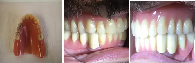 Figure 4: Dentures after occlusal adjustment and relining