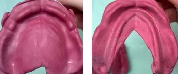 Figure 5: Primary impression with impression compound