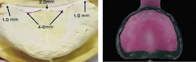 Figure 6: Primary cast with special tray