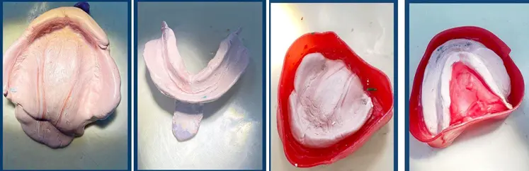 Figure 7: Final impression with zinc oxide eugenol impression material