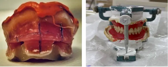 Figure 8: Acrylic denture bases with teeth arranged on articulator