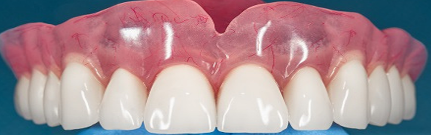 Figure 9: Final new complete dentures in patient mouth